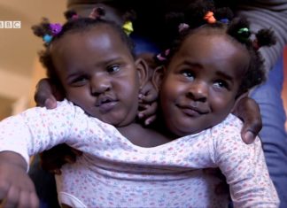 Seront-elles séparées avec succès : Ndèye et Marième, jumelles siamoises sénégalaises