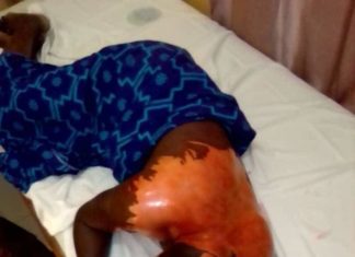 Darou Mousty : La Aawo A.N, ébouillantée à l’huile et menacée de répudiation par son mari chauffeur à la RTS, si elle maintient sa plainte contre sa coépouse