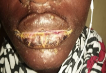 Thiaroye Sur-Mer: une curieuse maladie dermique « émerge » sur de jeunes pêcheurs
