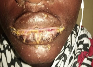 Thiaroye Sur-Mer: une curieuse maladie dermique « émerge » sur de jeunes pêcheurs