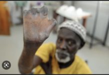 SANTÉ PUBLIQUE : Le Sénégal a enregistré 150 nouveaux cas de lèpre en 2022