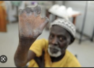 SANTÉ PUBLIQUE : Le Sénégal a enregistré 150 nouveaux cas de lèpre en 2022