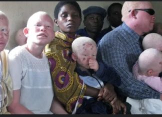 PRÉSIDENTIELLE 2024 : Les albinos craignent pour leur sécurité