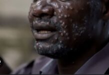 VARIOLE MPOX : Le Sénégal active son Centre des opérations d’urgence sanitaire